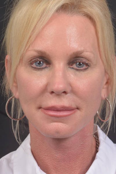 Facelift Before & After Gallery - Patient 246662 - Image 2