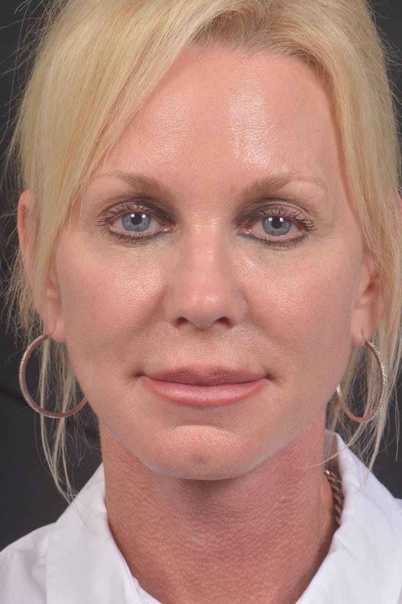 Facelift Before & After Gallery - Patient 246662 - Image 2