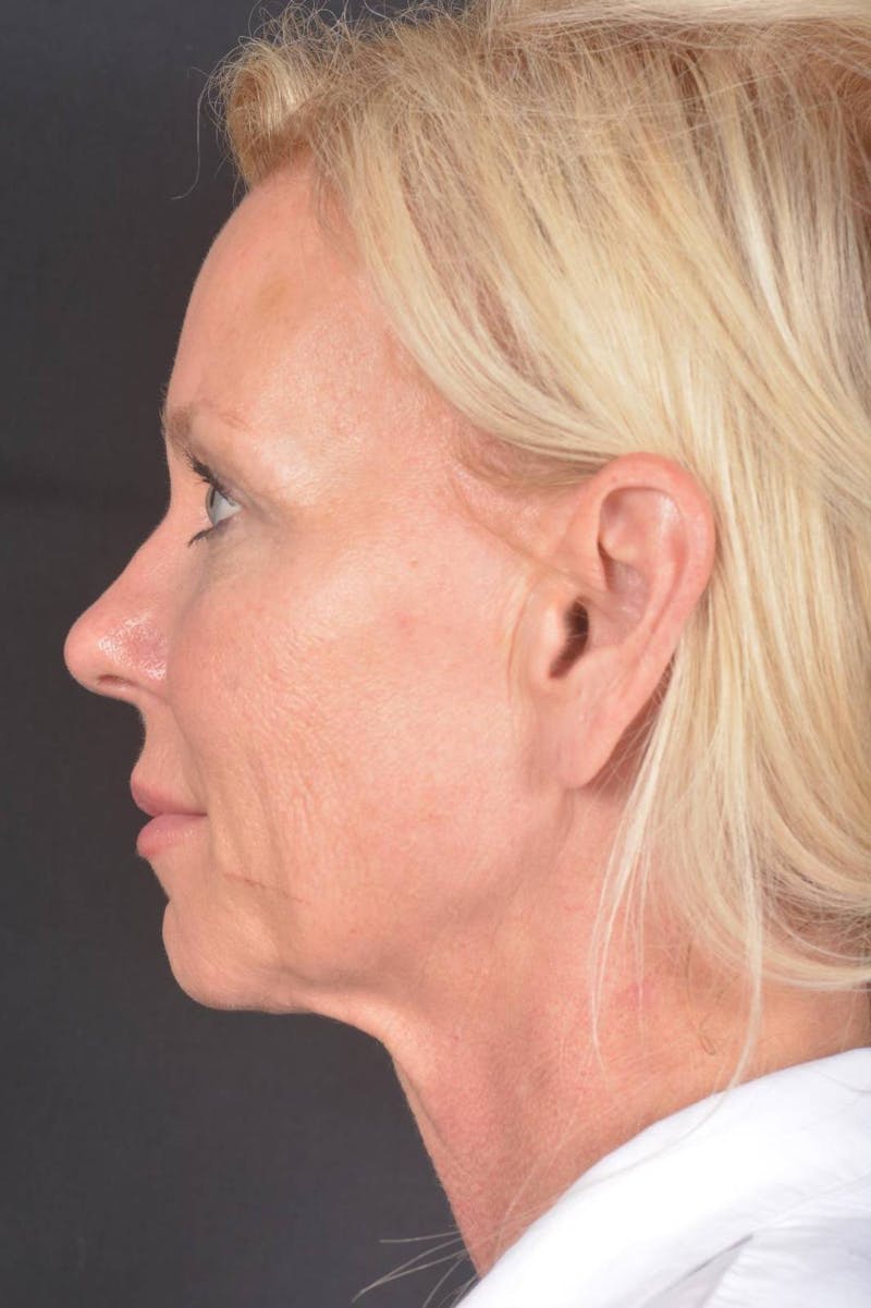 Facelift Before & After Gallery - Patient 246662 - Image 3