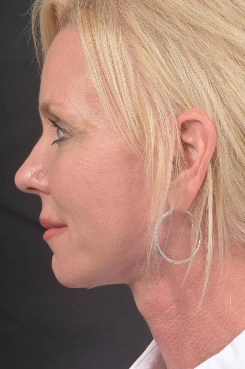 Facelift Before & After Gallery - Patient 246662 - Image 4