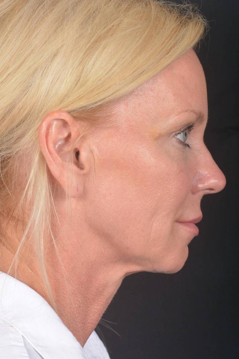 Facelift Before & After Gallery - Patient 246662 - Image 5