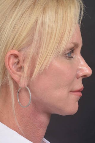Facelift Before & After Gallery - Patient 246662 - Image 6