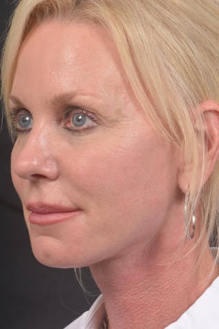 Facelift Before & After Gallery - Patient 246662 - Image 8