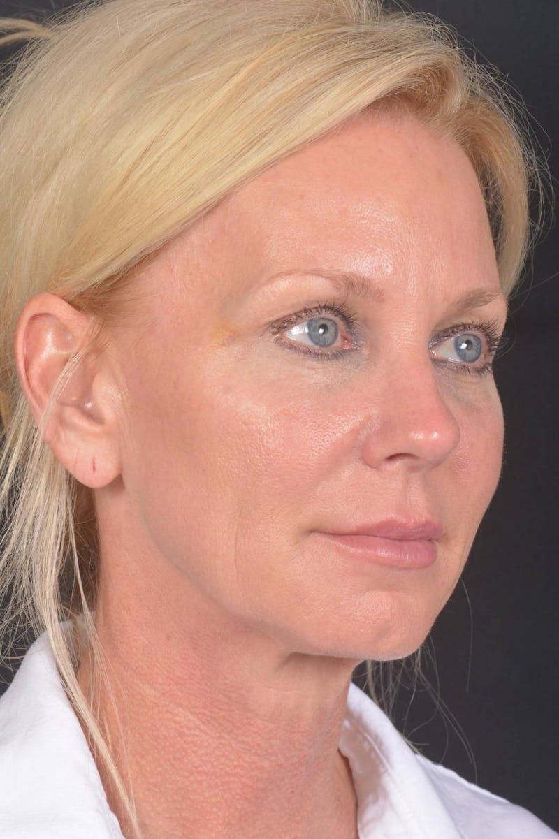 Facelift Before & After Gallery - Patient 246662 - Image 9