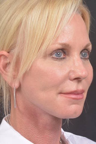 Facelift Before & After Gallery - Patient 246662 - Image 10