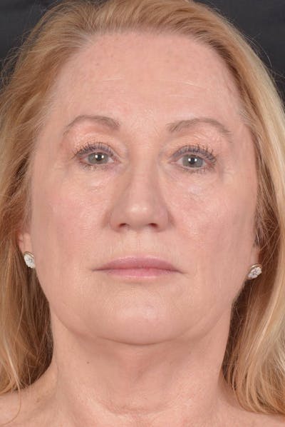 Facelift Before & After Gallery - Patient 132202 - Image 1