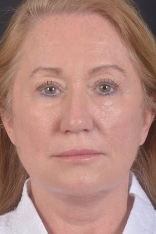 Facelift Before & After Gallery - Patient 132202 - Image 2