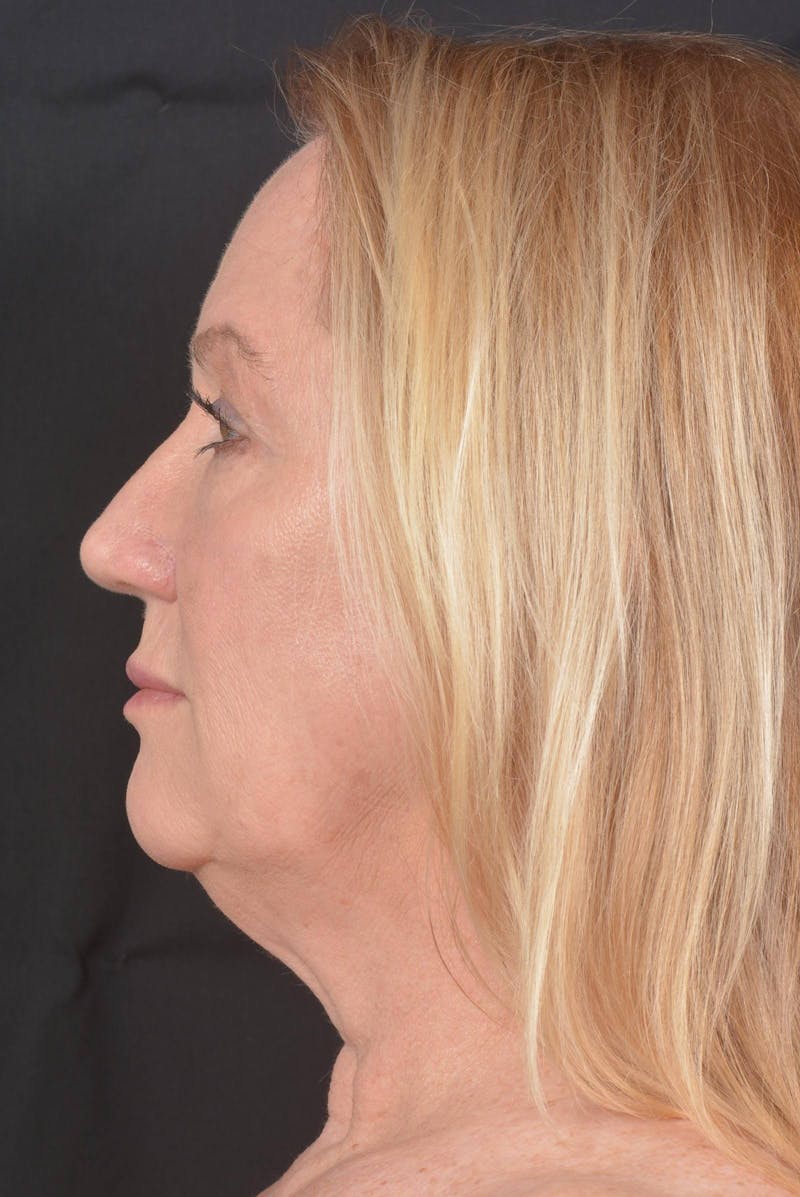 Facelift Before & After Gallery - Patient 132202 - Image 3