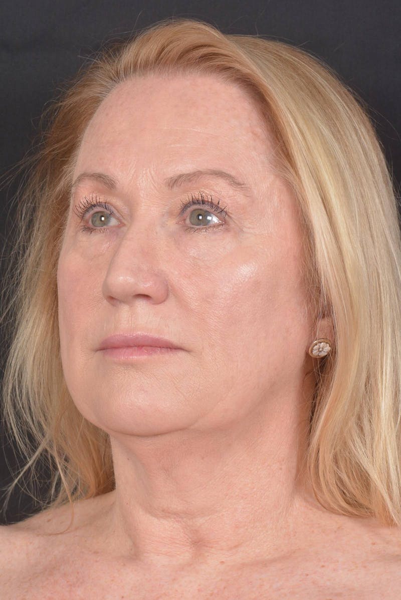 Facelift Before & After Gallery - Patient 132202 - Image 7