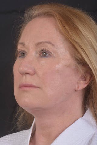 Facelift Before & After Gallery - Patient 132202 - Image 8