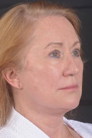 Facelift Before & After Gallery - Patient 132202 - Image 10