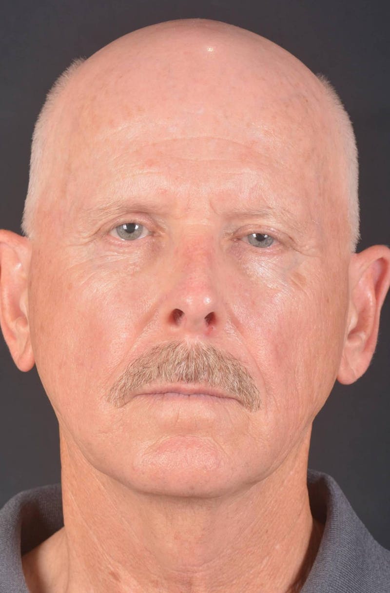 Facelift Before & After Gallery - Patient 358747 - Image 1