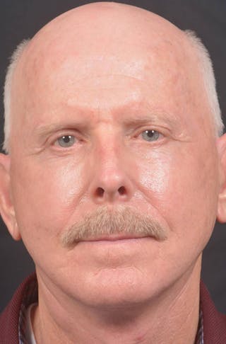 Facelift Before & After Gallery - Patient 358747 - Image 2