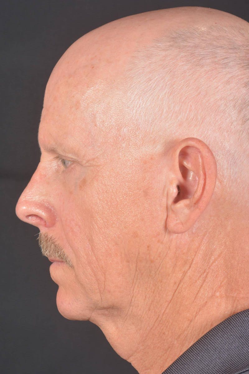 Facelift Before & After Gallery - Patient 358747 - Image 3