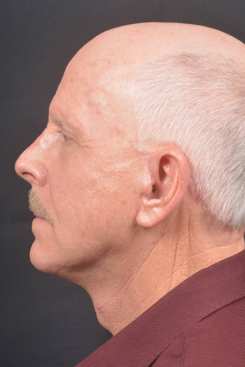Facelift Before & After Gallery - Patient 358747 - Image 4