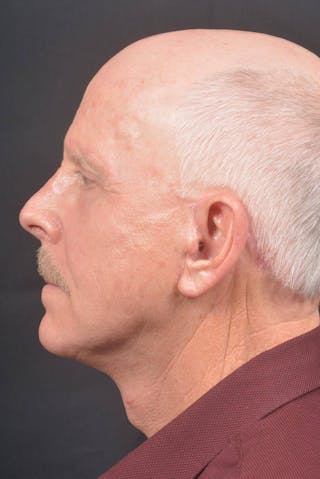 Facelift Before & After Gallery - Patient 358747 - Image 4