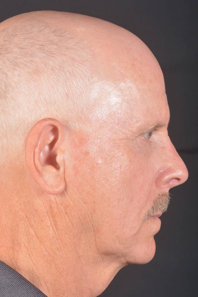 Facelift Before & After Gallery - Patient 358747 - Image 5