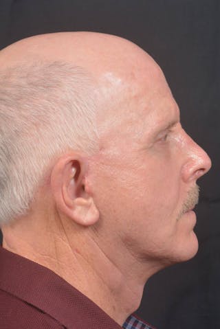 Facelift Before & After Gallery - Patient 358747 - Image 6