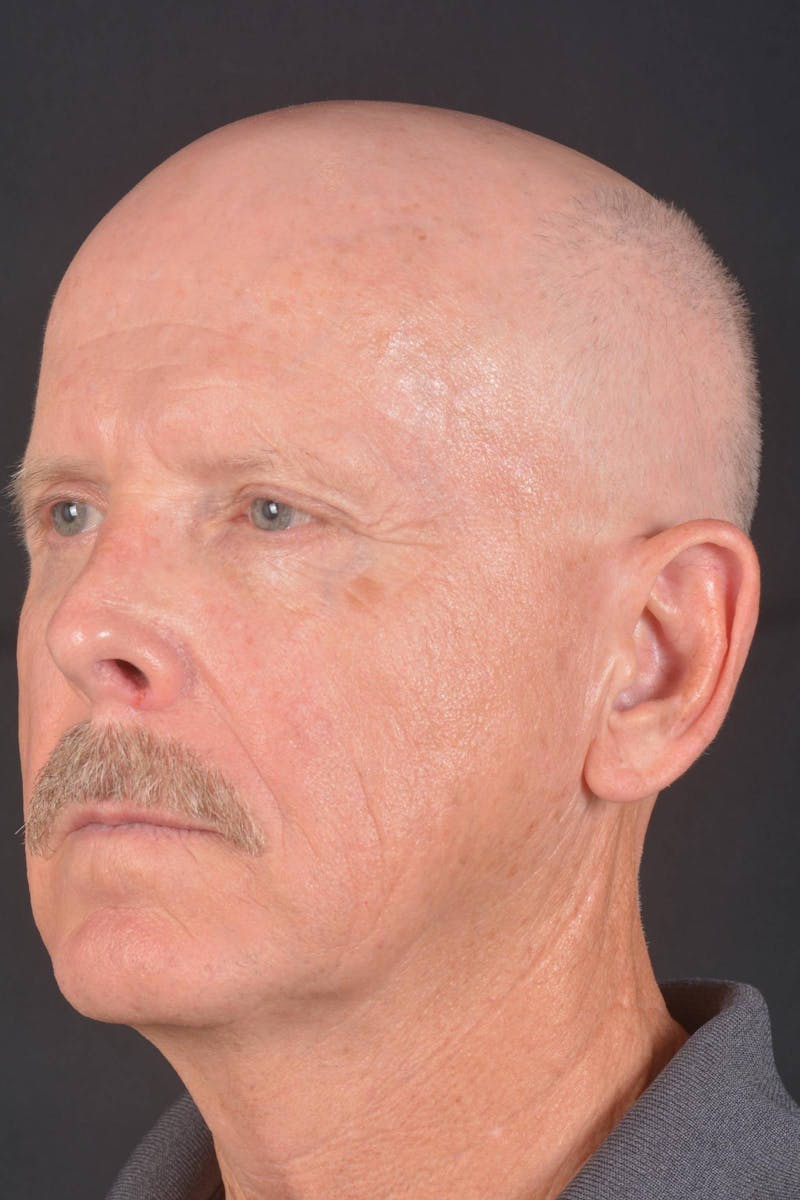 Facelift Before & After Gallery - Patient 358747 - Image 7