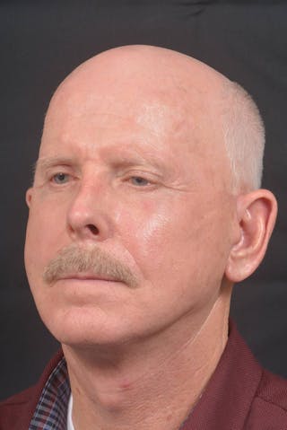 Facelift Before & After Gallery - Patient 358747 - Image 8