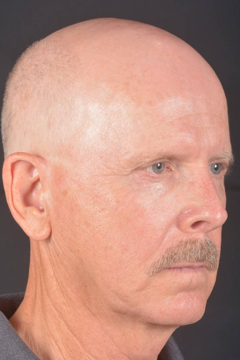 Facelift Before & After Gallery - Patient 358747 - Image 9