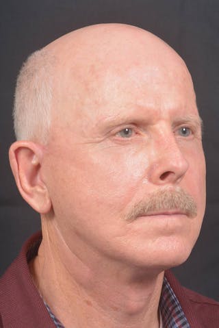 Facelift Before & After Gallery - Patient 358747 - Image 10