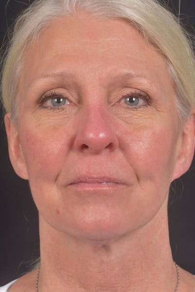 Facelift Before & After Gallery - Patient 208526 - Image 1