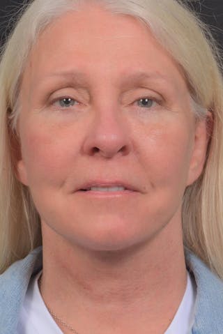 Facelift Before & After Gallery - Patient 208526 - Image 2