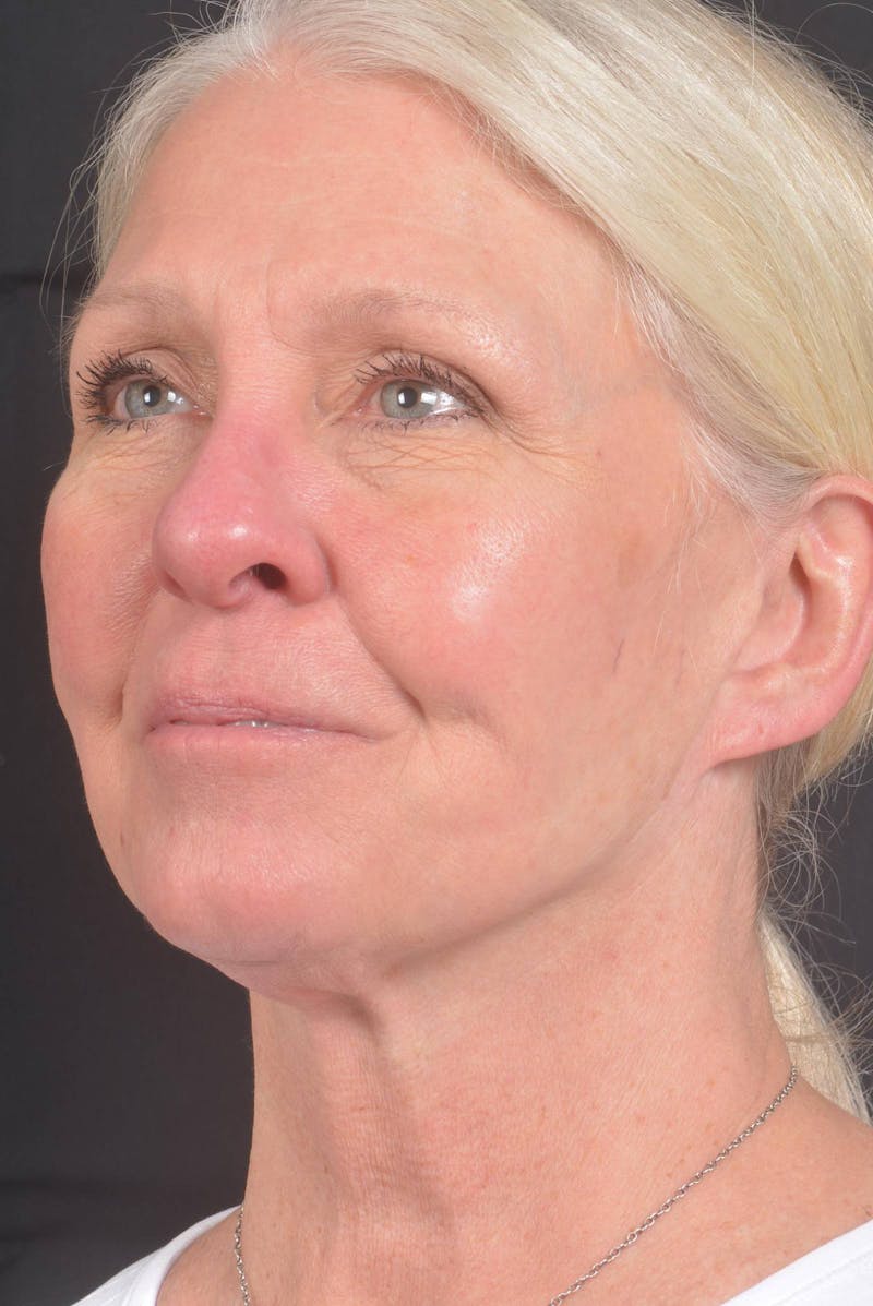 Facelift Before & After Gallery - Patient 208526 - Image 3