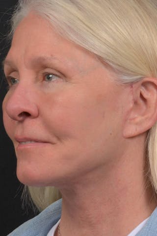 Facelift Before & After Gallery - Patient 208526 - Image 4