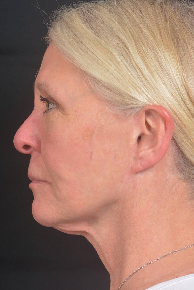 Facelift Before & After Gallery - Patient 208526 - Image 5