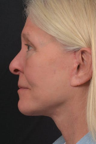 Facelift Before & After Gallery - Patient 208526 - Image 6