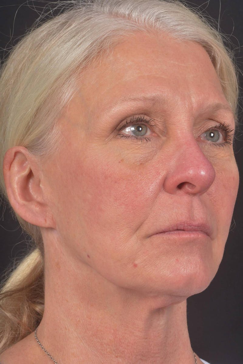 Facelift Before & After Gallery - Patient 208526 - Image 7