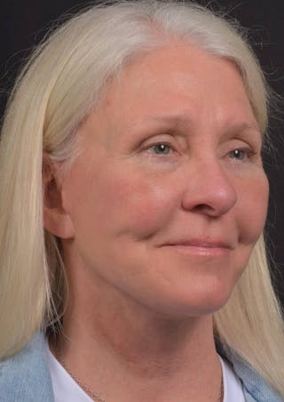 Facelift Before & After Gallery - Patient 208526 - Image 8