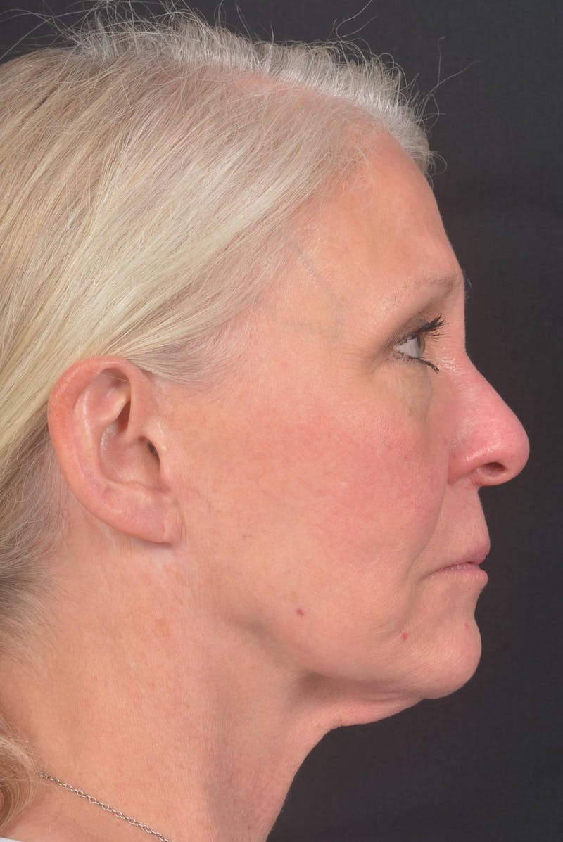 Facelift Before & After Gallery - Patient 208526 - Image 9