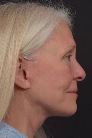 Facelift Before & After Gallery - Patient 208526 - Image 10
