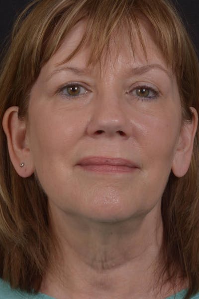 Facelift Before & After Gallery - Patient 407731 - Image 1