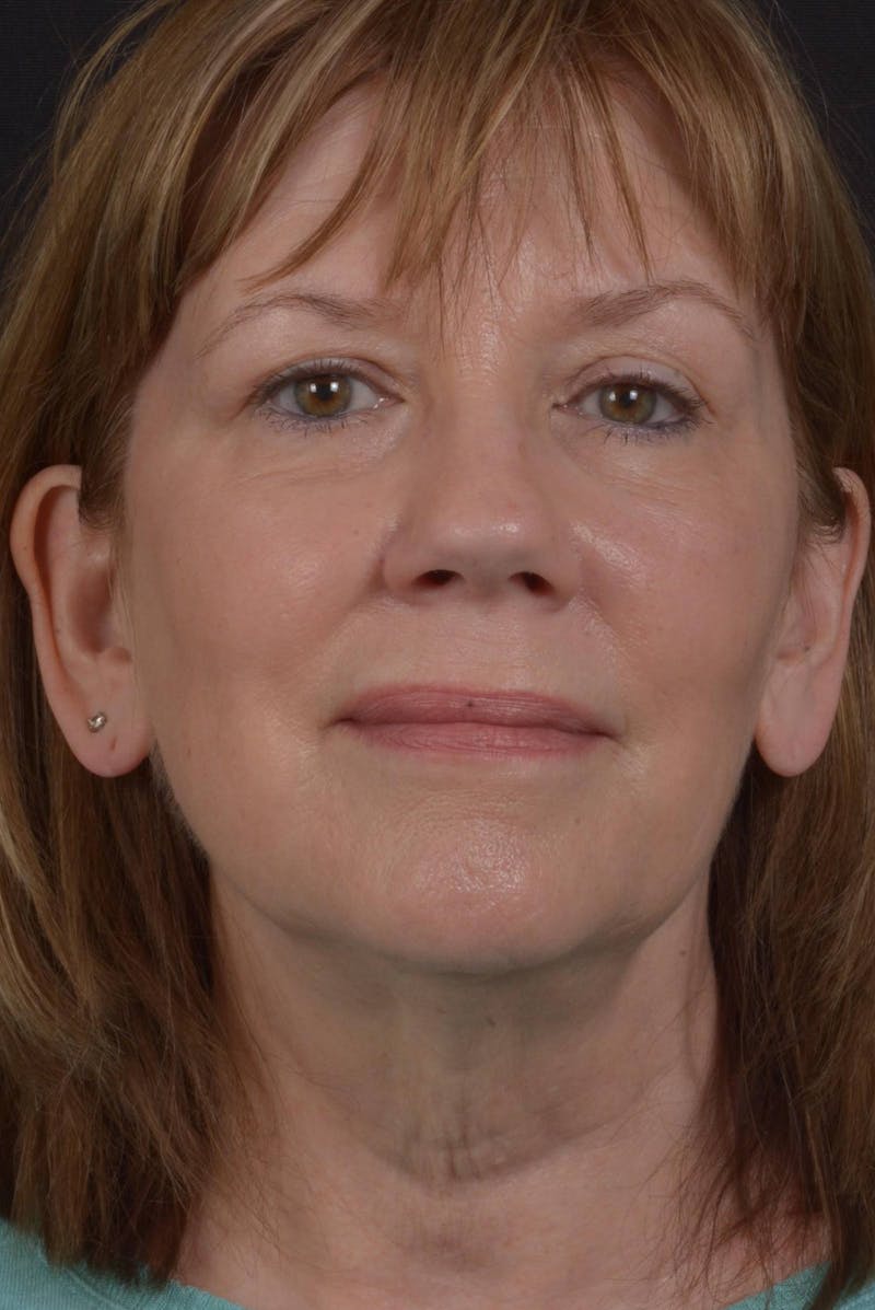 Facelift Before & After Gallery - Patient 407731 - Image 1