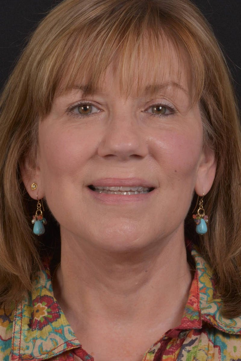 Facelift Before & After Gallery - Patient 407731 - Image 2