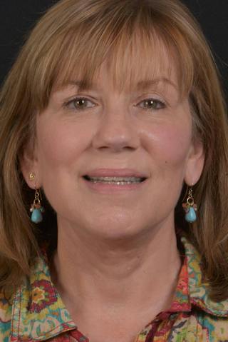 Facelift Before & After Gallery - Patient 407731 - Image 2
