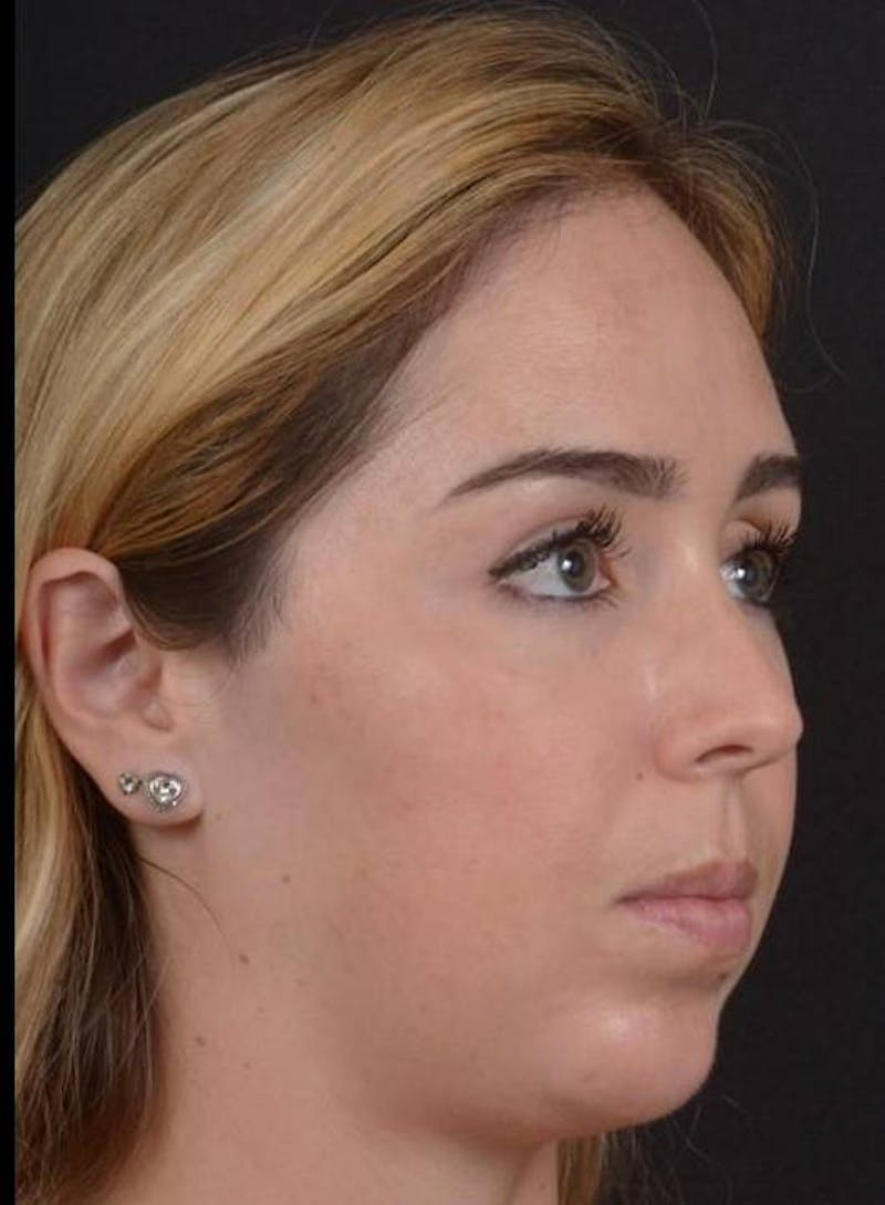 Facelift Before & After Gallery - Patient 139631 - Image 3