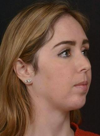 Facelift Before & After Gallery - Patient 139631 - Image 4