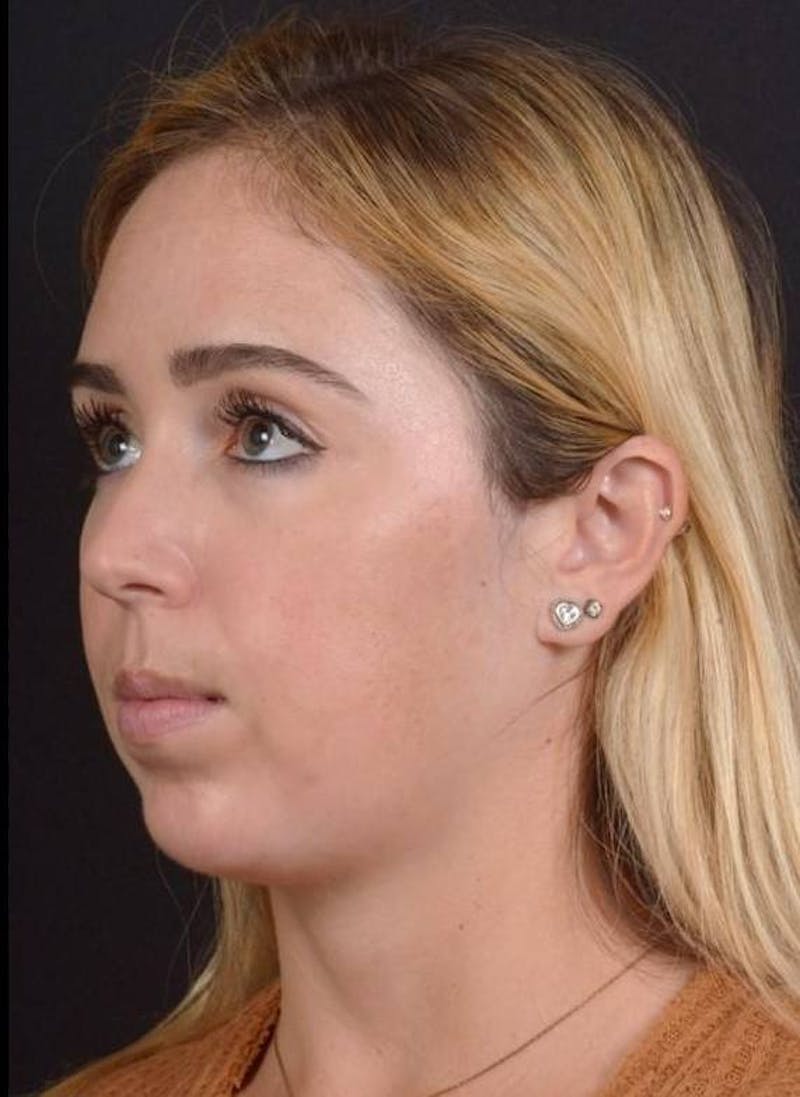 Facelift Before & After Gallery - Patient 139631 - Image 5