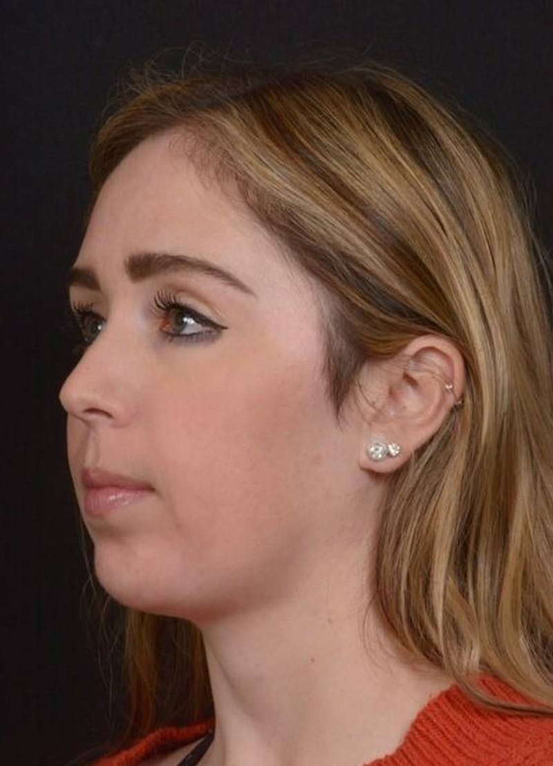 Facelift Before & After Gallery - Patient 139631 - Image 6