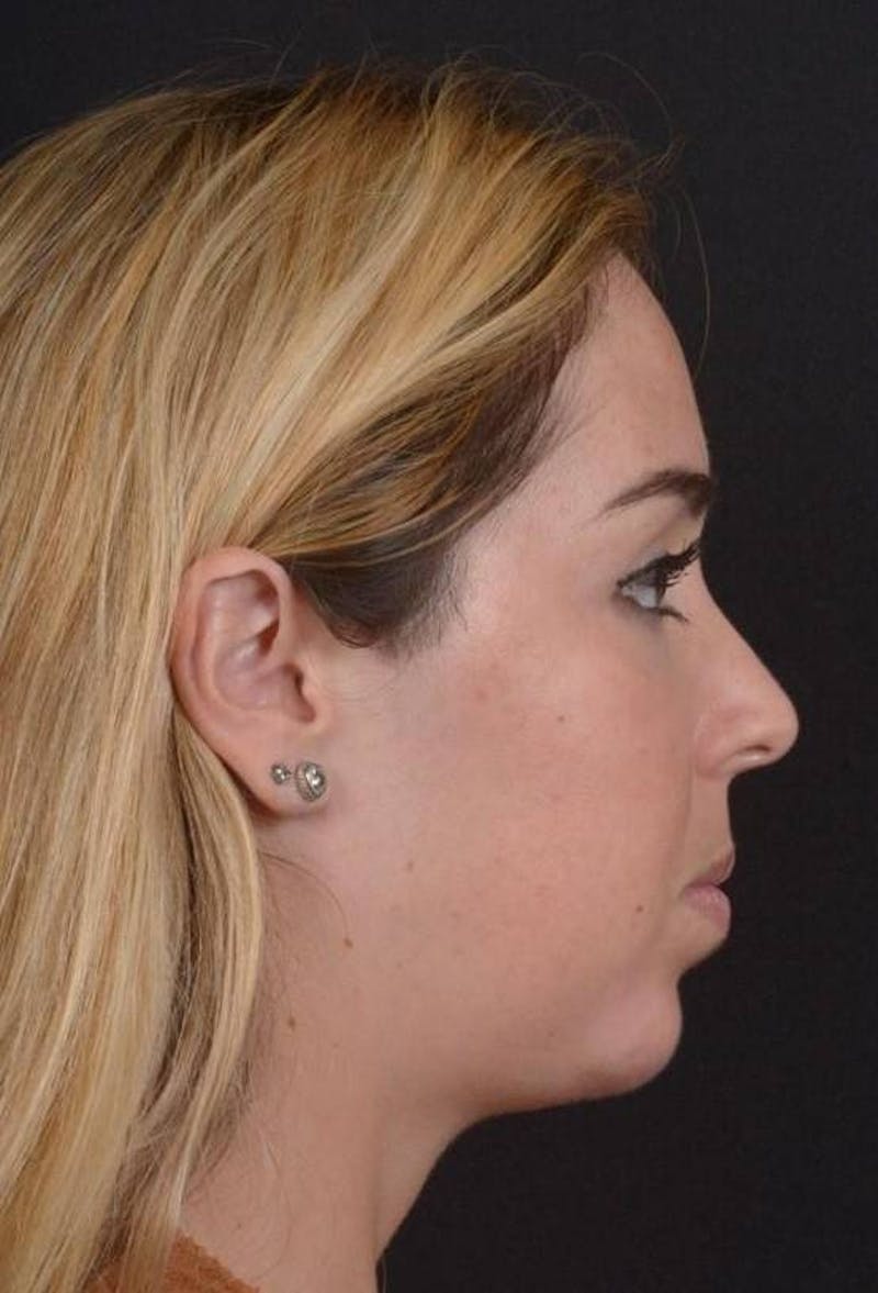 Facelift Before & After Gallery - Patient 139631 - Image 7