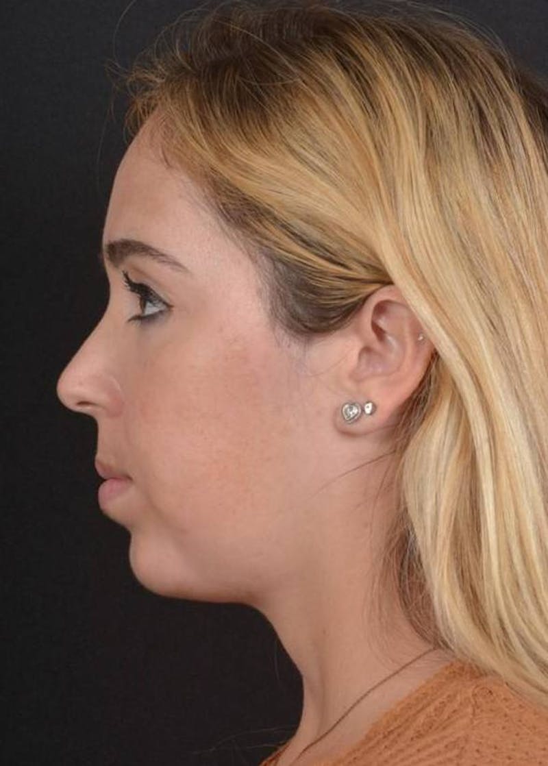 Facelift Before & After Gallery - Patient 139631 - Image 9