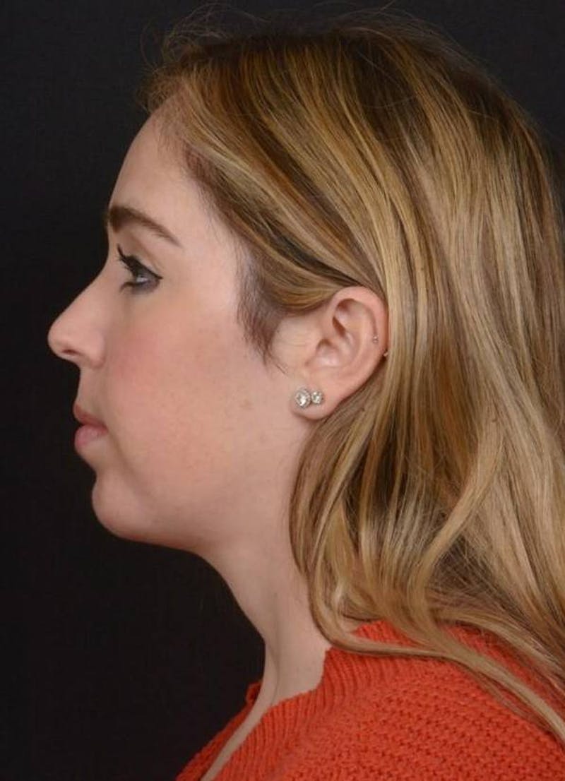 Facelift Before & After Gallery - Patient 139631 - Image 10