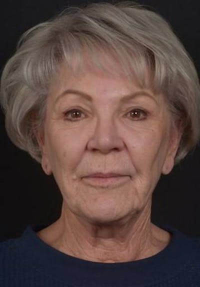Facelift Before & After Gallery - Patient 101724 - Image 1