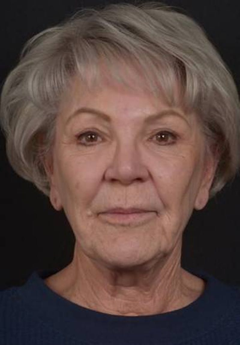 Facelift Before & After Gallery - Patient 101724 - Image 1