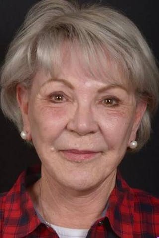 Facelift Before & After Gallery - Patient 101724 - Image 2